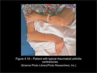 Figure 4.19 – Patient with typical rheumatoid arthritis
                              contractures.
                 (Science Photo Library/Photo Researchers, Inc.)
                                                         Copyright ©2009 by Pearson Education, Inc.
Medical Terminology: A Living Language, Fourth Edition       Upper Saddle River, New Jersey 07458
                                                                                           109
Bonnie F. Fremgen and Suzanne S. Frucht                                          All rights reserved.
 