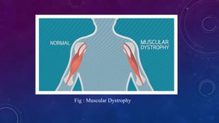 Fig : Muscular Dystrophy
 