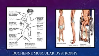 DUCHENNE MUSCULAR DYSTROPHY
 