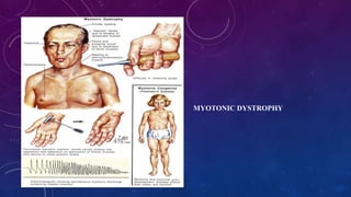 MYOTONIC DYSTROPHY
 