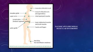 FACIOSCAPULOHUMERAL
MUSCULAR DYSTROPHY
 