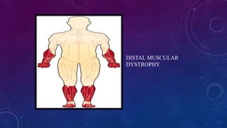 DISTAL MUSCULAR
DYSTROPHY
 
