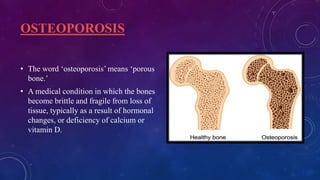 OSTEOPOROSIS
• The word ‘osteoporosis’ means ‘porous
bone.’
• A medical condition in which the bones
become brittle and fragile from loss of
tissue, typically as a result of hormonal
changes, or deficiency of calcium or
vitamin D.
 