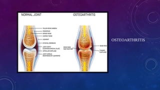 OSTEOARTHRITIS
 
