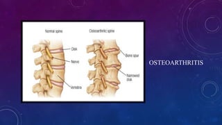 OSTEOARTHRITIS
 