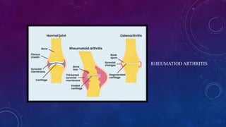 RHEUMATIOD ARTHRITIS
 
