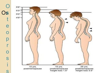 Os
O
s
t
e
o
p
r
o
s
i
s
 