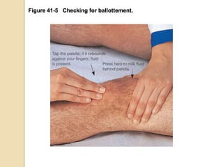 Figure 41-5 Checking for ballottement.
 