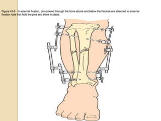 Figure 42-5 In external fixation, pins placed through the bone above and below the fracture are attached to external
fixation rods that hold the pins and bone in place.
 