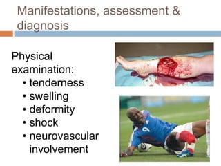 Manifestations, assessment &
diagnosis
Physical
examination:
• tenderness
• swelling
• deformity
• shock
• neurovascular
involvement
 