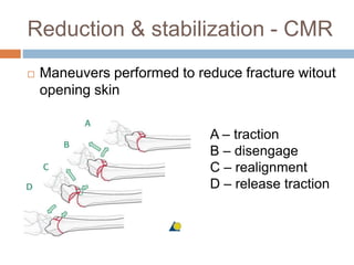 Reduction & stabilization - CMR
 Maneuvers performed to reduce fracture witout
opening skin
A – traction
B – disengage
C – realignment
D – release traction
 