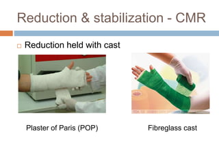 Reduction & stabilization - CMR
 Reduction held with cast
Plaster of Paris (POP) Fibreglass cast
 