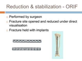 Reduction & stabilization - ORIF
 Performed by surgeon
 Fracture site opened and reduced under direct
visualisation
 Fracture held with implants
 