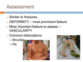 Assessment
 Similar to fractures
 DEFORMITY – most prominent feature
 Most important feature to assess –
VASCULARITY
 Common dislocations:
 Shoulder
 Hip
 