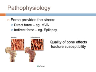Pathophysiology
 Force provides the stress:
 Direct force – eg. MVA
 Indirect force – eg. Epilepsy
Quality of bone effects
fracture susceptibility
 