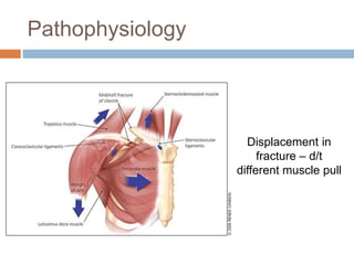 Pathophysiology
Displacement in
fracture – d/t
different muscle pull
 