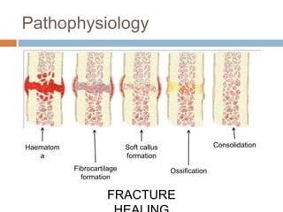 Pathophysiology
Haematom
a
Fibrocartilage
formation
Soft callus
formation
Ossification
Consolidation
FRACTURE
 