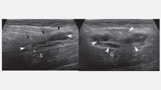 Acnormal Usg Week Musculoskeletal USG.pptx