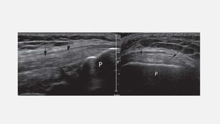 Acnormal Usg Week Musculoskeletal USG.pptx