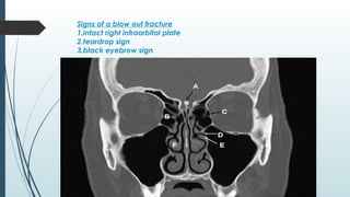 Tear Sign MUSCULOSKELTAL TRAUMA IMAGING (1).pptx