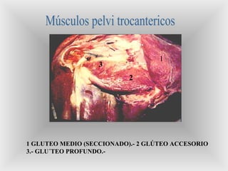 1
2
3
1 GLUTEO MEDIO (SECCIONADO).- 2 GLÚTEO ACCESORIO
3.- GLU´TEO PROFUNDO.-