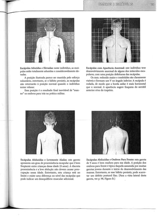 Escápulas Aduzidas e Elevadas: neste indivíduo, as escá-
pulas estão totalmente aduzidas e consideravelmente ele-
vadas.
A posição ilustrada parece ser mantida pelo esforço
voluntário, entretanto, se o hábito persistir, as escápulas
não retornarão à posição normal quando o indivíduo
tentar relaxar.
Essa posição é o resultado final inevitável de "man-
ter" os ombros para trás na prática militar.
1.. .
··.·.·.·..·.·.·.·.....r.t
... /
·~ --
Escápulas Abduzidas e Levemente Aladas: este garoto
apresenta um grau de proeminência escapular que é bem
freqüente entre crianças dessa idade (8 anos). A discreta
proeminência e a leve abdução não devem causar preo-
cupação nessa idade. Entretanto, esta criança está no
limite e existe uma diferença no nível das escápulas que
pode indicar um desequilíbrio muscular adicional.
Escápulas com Aparência Anormal: este indivíduo teve
desenvolvimento anormal de alguns dos músculos esca-
pulares, com uma posição defeituosa das escápulas.
Os mm. redondo maior e rombóides são claramente
visíveis e formam um V no ângulo inferior. A escápula é
rodada, de modo que a borda axilar é mais horizontal
que o normal. A aparência sugere fraqueza do serrátil
anterior e/ou do trapézio.
Escápulas Abduzidas e Ombros Para Frente: esta garota
de 9 anos é bem madura para sua idade. A posição dos
ombros para frente é típica daquela assumida por muitas
garotas jovens durante o início do desenvolvimento das
mamas. Entretanto, se esse hábito persistir, pode acarre-
tar um defeito postura! fixo. (Para a vista lateral desta
garota, ver p. 98, Figura B.)
 