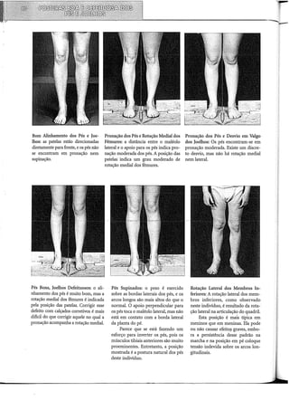 Bom Alinhamento dos Pés e Joe-
lhos: as patelas estão direcionadas
diretamente para frente, e os pés não
se encontram em pronação nem
supinação.
Pés Bons, Joelhos Defeituosos: o ali-
nhamento dos pés é muito bom, mas a
rotação mediai dos fêmures é indicada
pela posição das patelas. Corrigir esse
defeito com calçados corretivos é mais
difícil do que corrigir aquele no qual a
pronação acompanha a rotação mediai.
Pronação dos Pés e Rotação Mediai dos
Fêmures: a distância entre o maléolo
lateral e o apoio para os pés indica pro-
nação moderada dos pés. A posição das
patelas indica um grau moderado de
rotação mediai dos fêmures.
Pés Supinados: o peso é exercido
sobre as bordas laterais dos pés, e os
arcos longos são mais altos do que o
normal. O apoio perpendicular para
os pés toca o maléolo lateral, mas não
está em contato com a borda lateral
da planta do pé.
Parece que se está fazendo um
esforço para inverter os pés, pois os
músculos tibiais anteriores são muito
proeminentes. Entretanto, a posição
mostrada é a postura natural dos pés
deste indivíduo.
Pronação dos Pés e Desvio em Valgo
dos Joelhos: Os pés encontram-se em
pronação moderada. Existe um discre-
to desvio, mas não há rotação mediai
nem lateral.
Rotação Lateral dos Membros In-
feriores: A rotação lateral dos mem-
bros inferiores, como observado
neste indivíduo, é resultado da rota-
ção lateral na articulação do quadril.
Esta posição é mais típica em
meninos que em meninas. Ela pode
ou não causar efeito_~ graves, embo-
ra a persistência desse padrão na
marcha e na posição em pé coloque
tensão indevida sobre os arcos lon-
gitudinais.
 