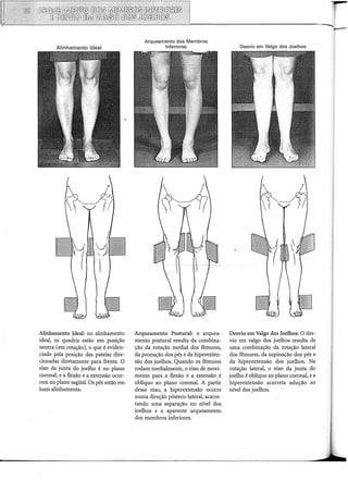 Alinhamento Ideal
Alinhamento Ideal: no alinhamento
ideal, os quadris estão em posição
neutra (em rotação), o que é eviden-
ciado pela posição das patelas dire-
cionadas diretamente para frente. O
eixo da junta do joelho é no plano
coronal, e a flexão e a extensão ocor-
rem no plano sagital. Os pés estão em
bom alinhamento.
Arqueamento dos Membros
Inferiores
Arqueamento Postura!: o arquea-
mento postura! resulta da combina-
ção da rotação mediai dos fêmures,
da pronação dos pés e da hiperexten-
são dos joelhos. Quando os fêmures
rodam medialmente, o eixo de movi-
mento para a flexão e a extensão é
oblíquo ao plano coronal. A partir
desse eixo, a hiperextensão ocorre
numa direção póstero-lateral, acarre-
tando uma separação no nível dos
joelhos e o aparente arqueamento
dos membros inferiores.
Desvio em Valgo dos Joelhos
Desvio em Valgo dos Joelhos: O des-
vio em valgo dos joelhos resulta de
uma combinação da rotação lateral
dos fêmures, da supinação dos pés e
da hiperextensão dos joelhos. Na
rotação lateral, o eixo da junta do
joelho é oblíquo ao plano coronal, e a
hiperextensão acarreta adução ao
nível dos joelhos.
 