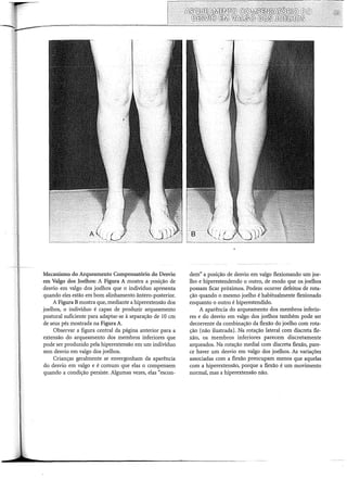 Mecanismo do Arqueamento Compensatório do Desvio
em Valgo dos Joelhos: A Figura A mostra a posição de
desvio em valgo dos joelhos que o individuo apresenta
quando eles estão em bom alinhamento ântero-posterior.
A Figura Bmostra que, mediante a hiperextensão dos
joelhos, o individuo é capaz de produzir arqueamento
postural suficiente para adaptar-se à separação de 10 em
de seus pés mostrada na Figura A.
Observar a figura central da página anterior para a
extensão do arqueamento dos membros inferiores que
pode ser produzido pela hiperextensão em um indivíduo
sem desvio em valgo dos joelhos.
Crianças geralmente se envergonham da aparência
do desvio em valgo e é comum que elas o compensem
quando a condição persiste. Algumas vezes, elas "escon-
dem" a posição de desvio em valgo flexionando um joe-
lho e hiperestendendo o outro, de modo que os joelhos
possam ficar próximos. Podem ocorrer defeitos de rota-
ção quando o mesmo joelho é habitualmente flexionado
enquanto o outro é hiperestendido.
A aparência do arqueamento dos membros inferio-
res e do desvio em valgo dos joelhos também pode ser
decorrente da combinação da flexão do joelho com rota-
ção (não ilustrada). Na rotação lateral com discreta fle-
xão, os membros inferiores parecem discretamente
arqueados. Na rotação mediai com discreta flexão, pare-
ce haver um desvio em valgo dos joelhos. As variações
associadas com a flexão preocupam menos que aquelas
com a hiperextensão, porque a flexão é um movimento
normal, mas a hiperextensão não.
 