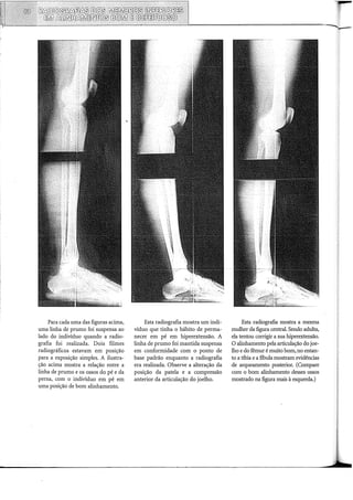 Para cada uma das figuras acima,
uma linha de prumo foi suspensa ao
lado do indivíduo quando a radio-
grafia foi realizada. Dois filmes
radiográficos estavam em posição
para a exposição simples. A ilustra-
ção acima mostra a relação entre a
linha de prumo e os ossos do pé e da
perna, com o indivíduo em pé em
uma posição de bom alinhamento.
Esta radiografia mostra um indi-
víduo que tinha o hábito de perma-
necer em pé em hiperex:tensão. A
linha de prumo foi mantida suspensa
em conformidade com o ponto de
base padrão enquanto a radiografia
era realizada. Observe a alteração da
posição da patela e a compressão
anterior da articulação do joelho.
Esta radiografia mostra a mesma
mulher da figura central. Sendo adulta,
ela tentou corrigir a sua hiperex:tensão.
O alinhamento pela articulação do joe-
lho e do fêmur é muito bom, no entan-
to a tíbia e a ffbula mostram evidências
de arqueamento posterior. (Compare
com o bom alinhamento desses ossos
mostrado na figura mais à esquerda.)
 