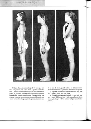 A Figura A mostra urna criança de lO anos que tem
urna boa postura para a sua idade, a qual se assemelha
mais à postura normal do adulto que de urna criança mais
jovem. As curvas da coluna vertebral são quase normais e
as escápulas, menos proeminentes. É característico que
crianças pequenas apresentem protrusão abdominal, mas
ocorre urna alteração perceptível aproximadamente aos
10-12 anos de idade, quando a linha da cintura se torna
relativamente menor e a protrusão abdominal desaparece.
A Figura B mostra urna criança de 9 anos cuja pos-
tura é quase a média para essa idade.
A Figura C mostra urna criança de ll anos cuja pos-
tura é muito defeituosa, com a cabeça para frente, cifose,
lordose, inclinação pélvica anterior e hiperextensão dos
joelhos.
 
