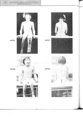 ANTES ANTES
DEPOIS DEPOIS
 