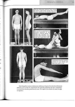 ·da
Músculos abdominais inferiores fracos. Incapaz
de manter a região lombar apoiada sobre a mesa
durante o abaixamento dos membros inferiores.
Erro no teste de comprimento dos
músculos posteriores da coxa
quando os músculos flexores do
quadril estão contraídos: com o
membro inferior abaíxado, a região
lombar não se apóia sobre a mesa.
Estas fotografias mostram alinhamento defeituoso, fraqueza dos músculos abdominais
inferiores, erro no teste do comprimento dos músculos posteriores da coxa e comprimen-
to normal dos músculos posteriores da coxa. (Ver registro dos achados do exame na pági-
na seguinte.)
 