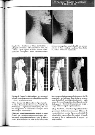Posições Boa e Defeituosa da Coluna Cervical: Para a
radiografia à esquerda, o indivíduo sentou-se ereto, com
a cabeça e a parte superior do tronco em bom alinha-
mento. Para a radiografia à direita, o mesmo indivíduo
Extensão. da Coluna Cervical: na Figura A, a cabeça está
inclinada para trás, a coluna cervical está hiperestendida
e o tórax e os ombros, elevados.
Coluna Cervical Reta (Flexionada): na Figura B, a cabe-
ça está em discreta inclinação anterior, as escápulas são
proeminentes e a região dorsal está reta. (Ver p. 334 para
uma vista posterior de um indivíduo com região dorsal
reta e escápulas proeminentes.)
Cabeçapara Frente com Tentativa de Correção: na Figura
C, parece que o indivíduo está tentando corrigir o que é,
basicamente, uma posição para frente. A curva do pescoço
começa de um modo típico na região cervical inferior, mas
sentou-se numa posição caída (relaxada), com arredon-
damento do dorso e a cabeça para frente. Como ilustra-
do, a coluna cervical está em extensão.
ocorre uma angulação aguda pro:ximalmente no nível da
sexta vértebra cervical. Acima desse nível, a curva parece
muito diminuída. O queixo é pressionado contra a região
anterior do pescoço. Esta posição distorcida, e não corrigi-
da, do pescoço é decorrente de uma falha em corrigir a
posição defeituosa da parte superior do tronco.
Cabeça Para FrenteAcentuada: na Figura D, o indivíduo
apresenta um alinhamento extremamente defeituoso do
pescoço e da coluna torácica. O grau de deformidade da
coluna torácica sugere epi:fisite. Este paciente foi tratado
por causa da dor na região posterior do pescoço e na
região occipital.
 
