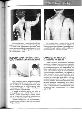 Esta fotografia mostra a incapacidade do indivíduo
de elevar o membro superior acima da cabeça quando
0 m. serrátil e o m. trapézio estão paralisados. O ala-
menta da borda mediai da escápula faz parecer que os
músculos rombóides são fracos quando, na realidade,
não o são. (Ver foto à direita.)
PARALISIA DO..M. TRAPÉZIO DIREITO
COM M. SERRATIL DIREITO NORMAL
Elevar o membro superior lateralmente no plano
coronal exige abdução da junta do ombro e rotação para
cima da escápula em adução. Na paralisia do m. trapé-
zio, a escápula não pode ser rodada em adução. Assim,
o movimento de abdução do ombro é limitado, como
mostra a fotografia acima à esquerda.
A elevação do membro superior para frente no
plano sagital requer que a escápula rode para cima em
abdução. Com o m. serrátil intacto, o membro superior
pode ser elevado mais alto em flexão que em abdução,
como mostra a fotografia acima à direita.
Com um m. serrátil fraco e um m. trapézio forte, o
membro superior pode ser elevado mais alto em abdu-
ção que em flexão.
Esta fotografia mostra a posição anormal da escá-
pula direita resultante de paralisia do m. trapézio e do
m. serrátil anterior. A extremidade acromial é abduzida e
deprimida. O ângulo inferior é rodado medialmente e
elevado. Os músculos rombóides são fortes.
CASOS DE PARALISIA DO
M. SERRÁTIL ÁNTERIOR
Durante o período de atuação hospitalar, os Kendalls
examinaram e trataram numerosos casos de paralisia
do m. serrátil anterior. Em função da etiologia, alguns
pacientes apresentavam dor associada à paralisia, mas
não na área do músculo em si; outros, não se queixaram
de dor antes, durante ou depois do início da paralisia.
As queixas iniciais relacionavam-se à incapacidade de
utilizar o membro superior normalmente. Em certos
casos, nos quais o início foi gradual, os pacientes não se
queixaram até a fraqueza se tornar cada vez mais pro-
nunciada. Quando os efeitos da fraqueza do m. serrátil
causaram problemas secundários envolvendo outras
estruturas, os pacientes se queixaram de dor ou descon-
forto em outras áreas que não o músculo, pescoço e
ombro. O importante dessa história é o fato de que o
nervo torácico longo é puramente motor. (Ver p. 252 e o
Apêndice B.)
 