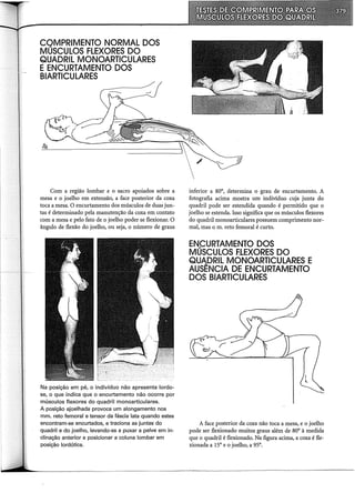 ~~~t~~~§~l~x~~fs~Ó DOS
QUADRIL MONOARTICULARES
E ENCURTAMENTO DOS
BIARTICULARES
Com a região lombar e o sacro apoiados sobre a
mesa e o joelho em extensão, a face posterior da coxa
toca a mesa. O encurtamento dos músculos de duas jun-
tas é determinado pela manutenção da coxa em contato
com a mesa e pelo fato de o joelho poder se flexionar. O
ângulo de flexão do joelho, ou seja, o número de graus
Na posição em pé, o indivíduo não apresenta lordo-
se, o que indica que o encurtamento não ocorre por
músculos flexores do quadril monoarticulares.
A posição ajoelhada provoca um alongamento nos
mm. reto femoral e tensor da fáscia lata quando estes
encontram-se encurtados, e traciona as juntas do
quadril e do joelho, levando-as a puxar a pelve em in-
clinação anterior e posicionar a coluna lombar em
posição lordótica.
inferior a soa, determina o grau de encurtamento. A
fotografia acima mostra um indivíduo cuja junta do
quadril pode ser estendida quando é permitido que o
joelho se estenda. Isso significa que os músculos flexores
do quadril monoarticulares possuem comprimento nor-
mal, mas o m. reto femoral é curto.
EN..CURTAMENTO DOS
MUSCULOS F.LEXORES DO
QUADRIL MONOARTICULARES E
AUSÊNCIA DE ENCURTAMENTO
DOS BIARTICULARES
A face posterior da coxa não toca a mesa, e o joelho
pode ser flexionado muitos graus além de soa à medida
que o quadril é flexionado. Na figura acima, a coxa é fle-
xionada a 15a e o joelho, a 95a.
 