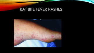 Rat Scratch Fever Rash Comprehensive Overview of Mushika Visha and Rat-Bite Fever: Ayurvedic ...