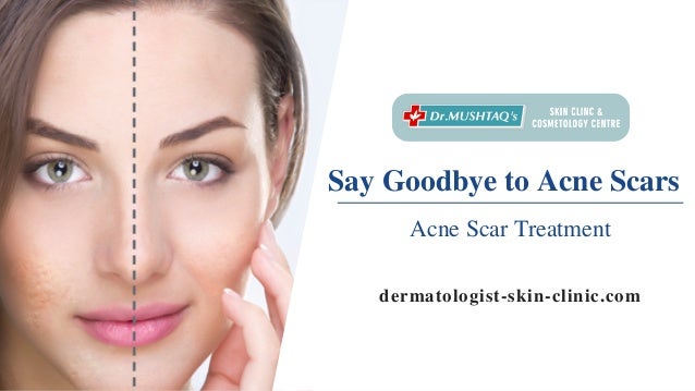 acne skin care clinic