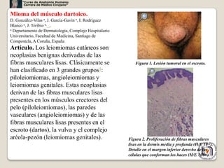 “Curso de Anatomía Humana:
       Carrera de Médico Cirujano”


Mioma del músculo dartoico.
D. González-Vilas a, J. García-Gavín a, I. Rodríguez
Blanco a, J. Toribio a, ,
a Departamento de Dermatología, Complejo Hospitalario

Universitario, Facultad de Medicina, Santiago de
Compostela, A Coruña, España
Artículo. Los leiomiomas cutáneos son
neoplasias benignas derivadas de las
fibras musculares lisas. Clásicamente se                   Figura 1. Lesión tumoral en el escroto.
han clasificado en 3 grandes grupos1:
piloleiomiomas, angioleiomiomas y
leiomiomas genitales. Estas neoplasias
derivan de las fibras musculares lisas
presentes en los músculos erectores del
pelo (piloleiomiomas), las paredes
vasculares (angioleiomiomas) y de las
fibras musculares lisas presentes en el
escroto (dartos), la vulva y el complejo
aréola-pezón (leiomiomas genitales).                    Figura 2. Proliferación de fibras musculares
                                                        lisas en la dermis media y profunda (H/E 10×).
                                                        Detalle en el margen inferior derecho de las
                                                        células que conforman los haces (H/E 100×). 46
 