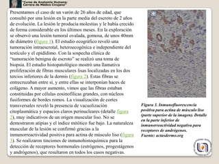 “Curso de Anatomía Humana:
       Carrera de Médico Cirujano”

Presentamos el caso de un varón de 26 años de edad, que
consultó por una lesión en la parte media del escroto de 2 años
de evolución. La lesión le producía molestias y le había crecido
de forma considerable en los últimos meses. En la exploración
se observó una lesión tumoral ovalada, gomosa, de unos 40mm
de diámetro (figura 1). El estudio ecográfico reveló una
tumoración intraescrotal, heteroecogénica e independiente del
testículo y el epidídimo. Con la sospecha clínica de
“tumoración benigna de escroto” se realizó una toma de
biopsia. El estudio histopatológico mostró una llamativa
proliferación de fibras musculares lisas localizadas en los dos
tercios inferiores de la dermis (figura 2). Estas fibras se
entrecruzaban entre sí, y entre ellas se interponían haces de
colágeno. A mayor aumento, vimos que las fibras estaban
constituidas por células eosinofílicas grandes, con núcleos
fusiformes de bordes romos. La visualización de cortes
transversales reveló la presencia de vacuolización                 Figura 3. Inmunofluorescencia
citoplasmática y espacios claros perinucleares (detalle figura     positiva para actina de músculo liso
                                                                   (parte superior de la imagen). Detalle
2), muy indicativos de un origen muscular liso. No se
                                                                   en la parte inferior de
demostraron atipias y el índice mitótico fue bajo. La naturaleza   inmunorreactividad negativa para
muscular de la lesión se confirmó gracias a la                     receptores de andrógenos.
inmunorreactividad positiva para actina de músculo liso (figura    Fuente: actasdermo.org
3). Se realizaron tinciones de inmunohistoquímica para la
detección de receptores hormonales (estrógenos, progestágenos
y andrógenos), que resultaron en todos los casos negativas.                                             47
 