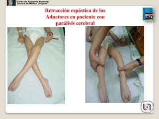 “Curso de Anatomía Humana:
 Carrera de Médico Cirujano”


                        Retracción espástica de los
                        Aductores en paciente con
                            parálisis cerebral




                                                      49
 