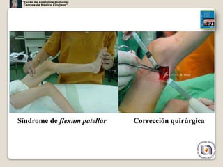 “Curso de Anatomía Humana:
  Carrera de Médico Cirujano”




Síndrome de flexum patellar     Corrección quirúrgica



                                                        51
 