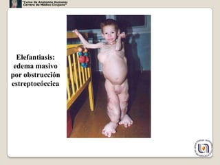 “Curso de Anatomía Humana:
    Carrera de Médico Cirujano”




  Elefantiasis:
 edema masivo
por obstrucción
estreptocóccica




                                  53
 