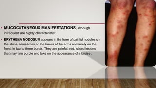 • MUCOCUTANEOUS MANIFESTATIONS, although
infrequent, are highly characteristic:
• ERYTHEMA NODOSUM appears in the form of painful nodules on
the shins, sometimes on the backs of the arms and rarely on the
front, in two to three bursts. They are painful, red, raised lesions
that may turn purple and take on the appearance of a bruise .
 