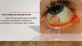 • PHLYCTENULAR CONJUNCTIVITIS :
begins with generalized pain and irritation
in one eye accompanied by watering and
photophobia. On examination, grey or yellow
 