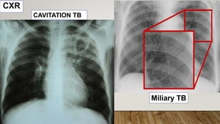 CXR
Miliary TB
CAVITATION TB
 