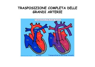 TRASPOSIZIONE COMPLETA DELLE
GRANDI ARTERIE
 