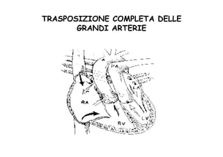 TRASPOSIZIONE COMPLETA DELLE
GRANDI ARTERIE
 