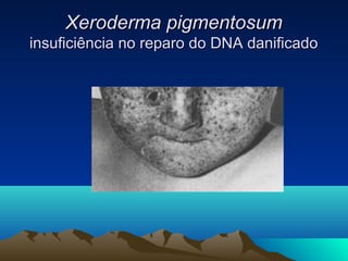 Xeroderma ppiiggmmeennttoossuumm 
iinnssuuffiicciiêênncciiaa nnoo rreeppaarroo ddoo DDNNAA ddaanniiffiiccaaddoo 
 