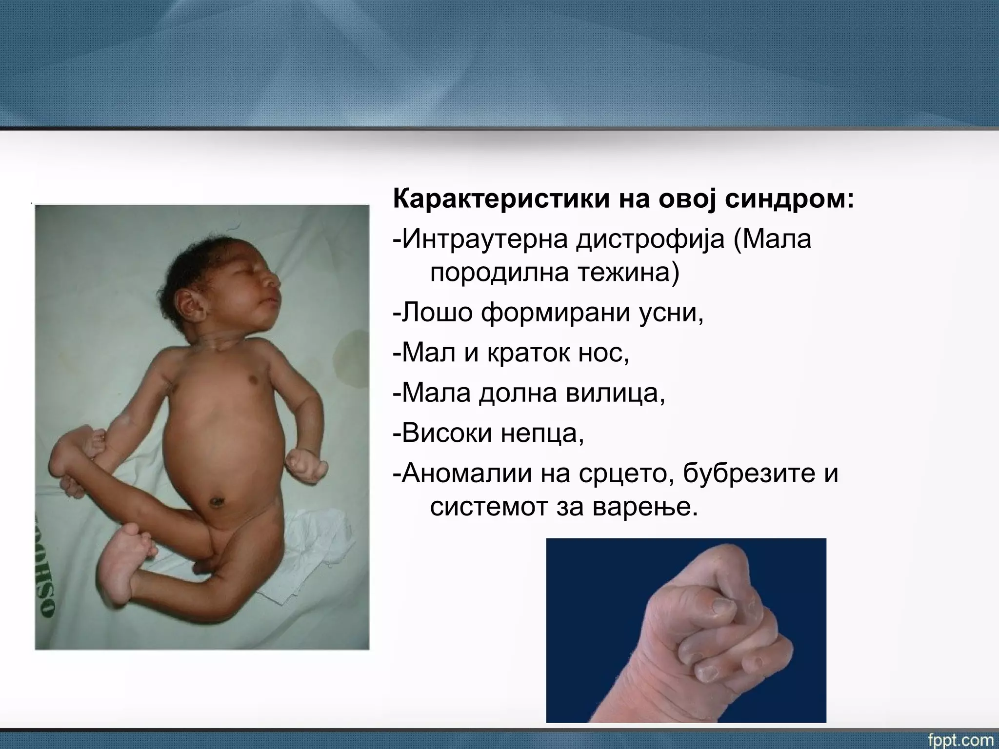 Карактеристики на овој синдром:
-Интраутерна дистрофија (Мала
породилна тежина)
-Лошо формирани усни,
-Мал и краток нос,
-Мала долна вилица,
-Високи непца,
-Аномалии на срцето, бубрезите и
системот за варење.
 